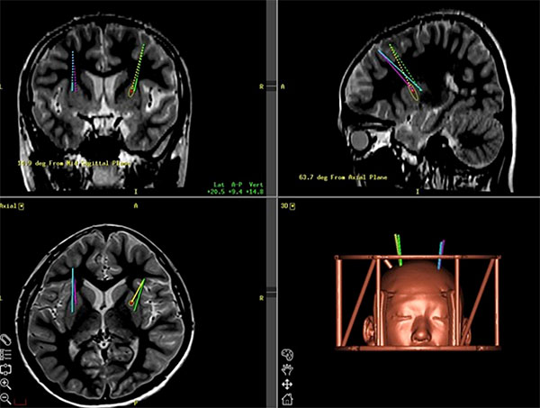 定位脳手術のイメージング画像