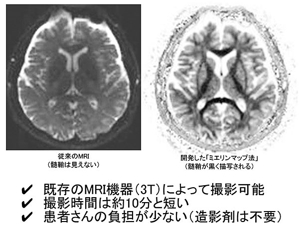 性 症 寿命 硬化 多発