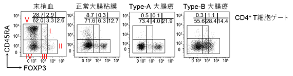 大腸がんにはFOXP3弱発現の細胞群（Fr-III）が多数浸潤する腫瘍が存在する。