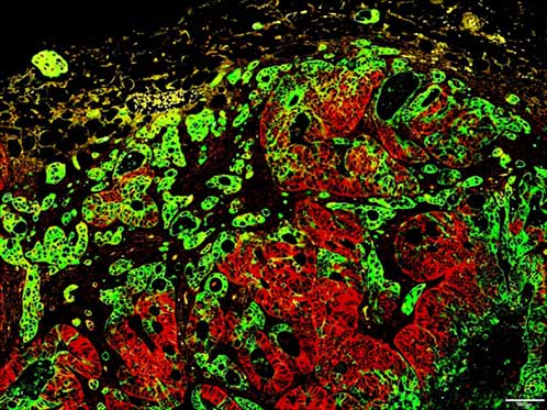 赤く染色されているのは、ヒトの大腸がんにみられたがん幹細胞マーカーを発現する細胞