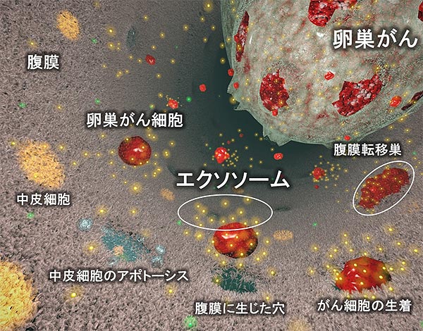 腹膜 播種