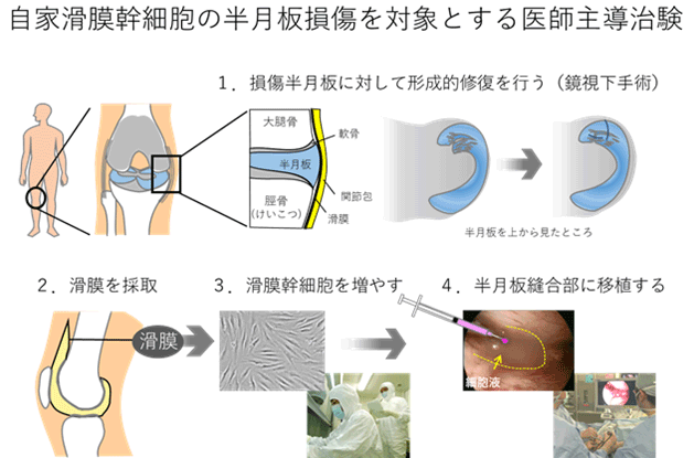 自家滑膜幹細胞の半月板損傷を対象とする医師主導治験 開始のお知らせ 国内で初めての半月板損傷患者を対象とした再生医療等製品の治験開始 国立研究開発法人日本医療研究開発機構