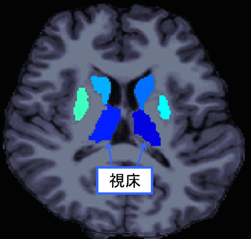 統合失調症における社会機能障害への大脳皮質下領域の関与を発見