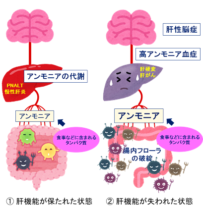 図2 肝性脳症