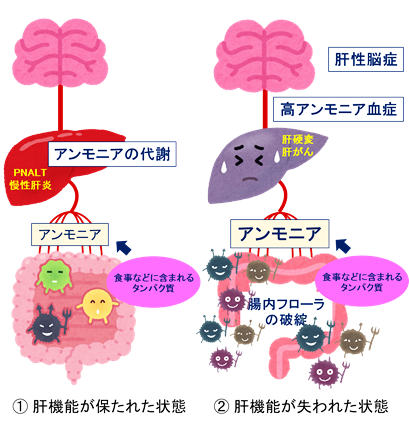 図2　肝性脳症