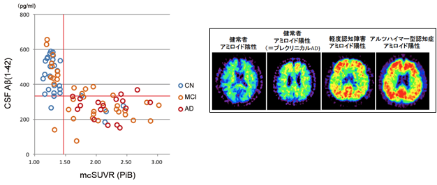 J-ADNI研究によりアルツハイマー病早期段階(軽度認知障害)の進行過程を解明