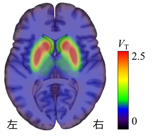 図3 線条体におけるドーパミンD2受容体のPET画像