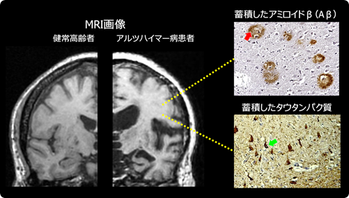 図1 アルツハイマー病における脳の変化