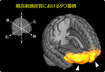 図2 意欲低下が強いアルツハイマー病患者におけるタウ蓄積