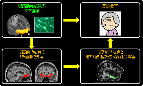 図3　アルツハイマー病におけるタウ蓄積ならびに神経障害と意欲低下の関連