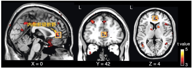 図1. オキシトシン反復投与で脳活動改善効果を有意に認めたヒト脳の内側前頭前野