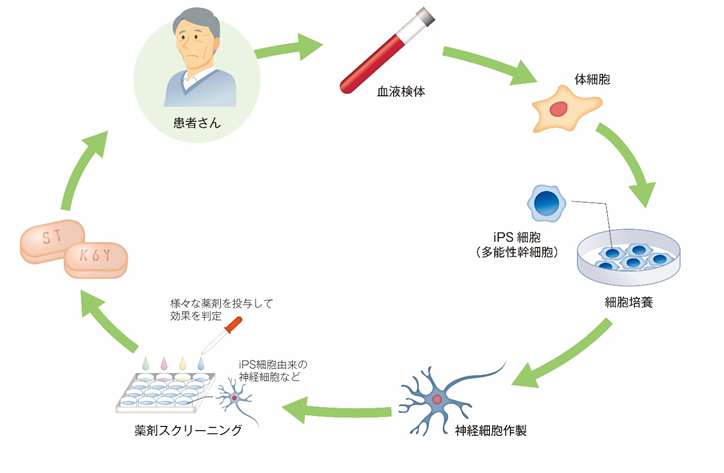 筋萎縮性側索硬化症 Als に対するips細胞創薬に基づいた医師主導治験を開始 国立研究開発法人日本医療研究開発機構