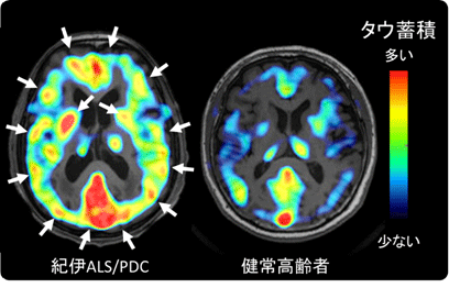 図1　代表的な紀伊ALS/PDC患者におけるタウ蓄積