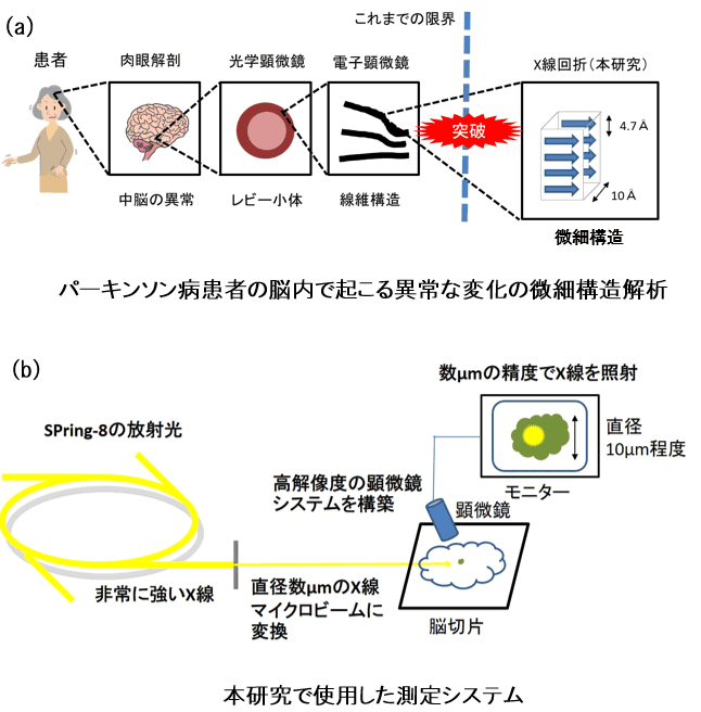 患者脳の微細構造解析でパーキンソン病の新たな疾患概念を提唱