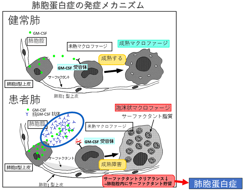 指定難病「自己免疫性肺胞蛋白症」の病因解明にもとづく新しい治療法の開発