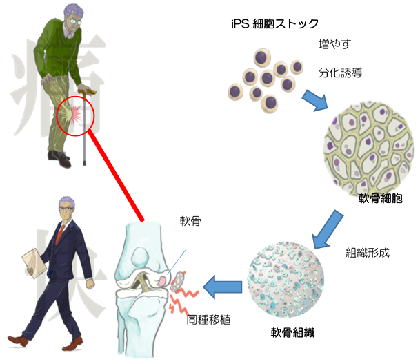 9.同種iPS細胞由来軟骨移植までの流れのイメージ（詳細は本文中に記載）