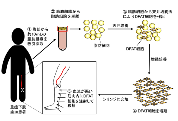 患者自身の脂肪細胞から作られる「DFAT細胞」を用いて世界初の血管再生医療の臨床研究を開始　成果イメージ図　内容は本文中に記載