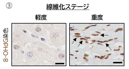 成果情報






脂肪肝炎の新たな治療法開発に期待！―サイトグロビンの発現と肝線維化の関係が明らかに―