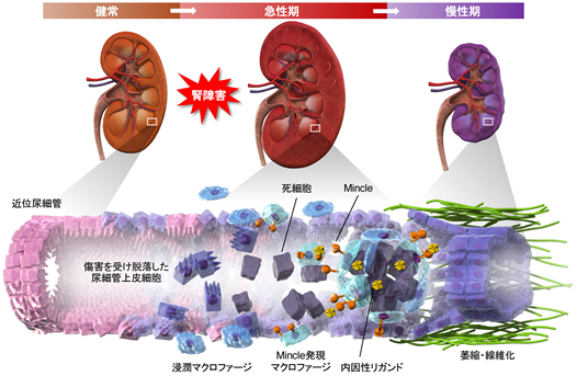 死細胞センサーMincleによる急性腎障害の慢性化メカニズムを解明