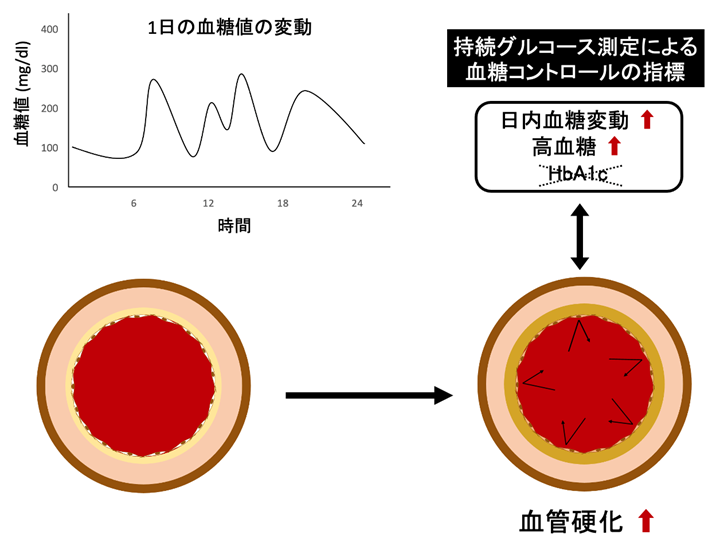 大きな血糖変動が血管硬化に関連することを明らかに～糖尿病治療における血糖変動管理の重要性～
