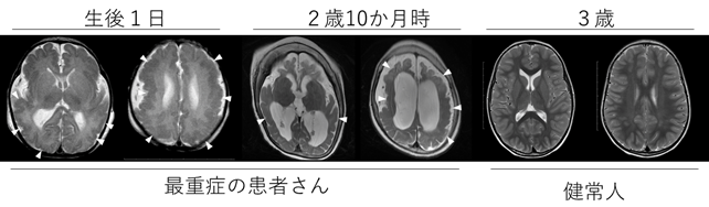 大脳皮質形成異常症の1つである「多小脳回」(病的に小さい脳回が多発する病気)の新たな原因遺伝子ATP1A3を同定