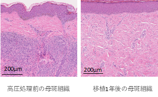 色素性母斑に対する皮膚再生臨床試験が終了 高圧殺細胞装置の医師主導治験へ 国立研究開発法人日本医療研究開発機構
