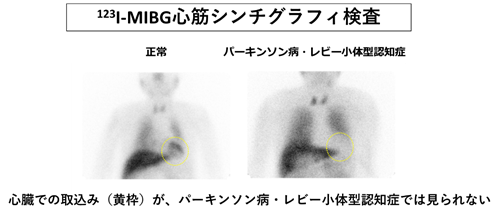 123I-メタヨードベンジルグアニジン（MIBG）心筋シンチグラフィは パーキンソン病・レ小体型認知症の診断に 特異的な検査であることを証明の概要図